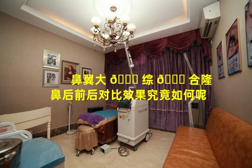 鼻翼大 🐋 综 🐕 合隆鼻后前后对比效果究竟如何呢